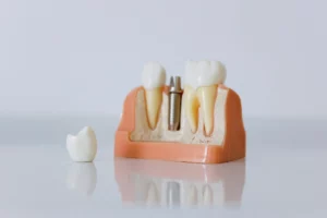 Prix d'un implant dentaire en Suisse — Cabinet Haerri Lausanne