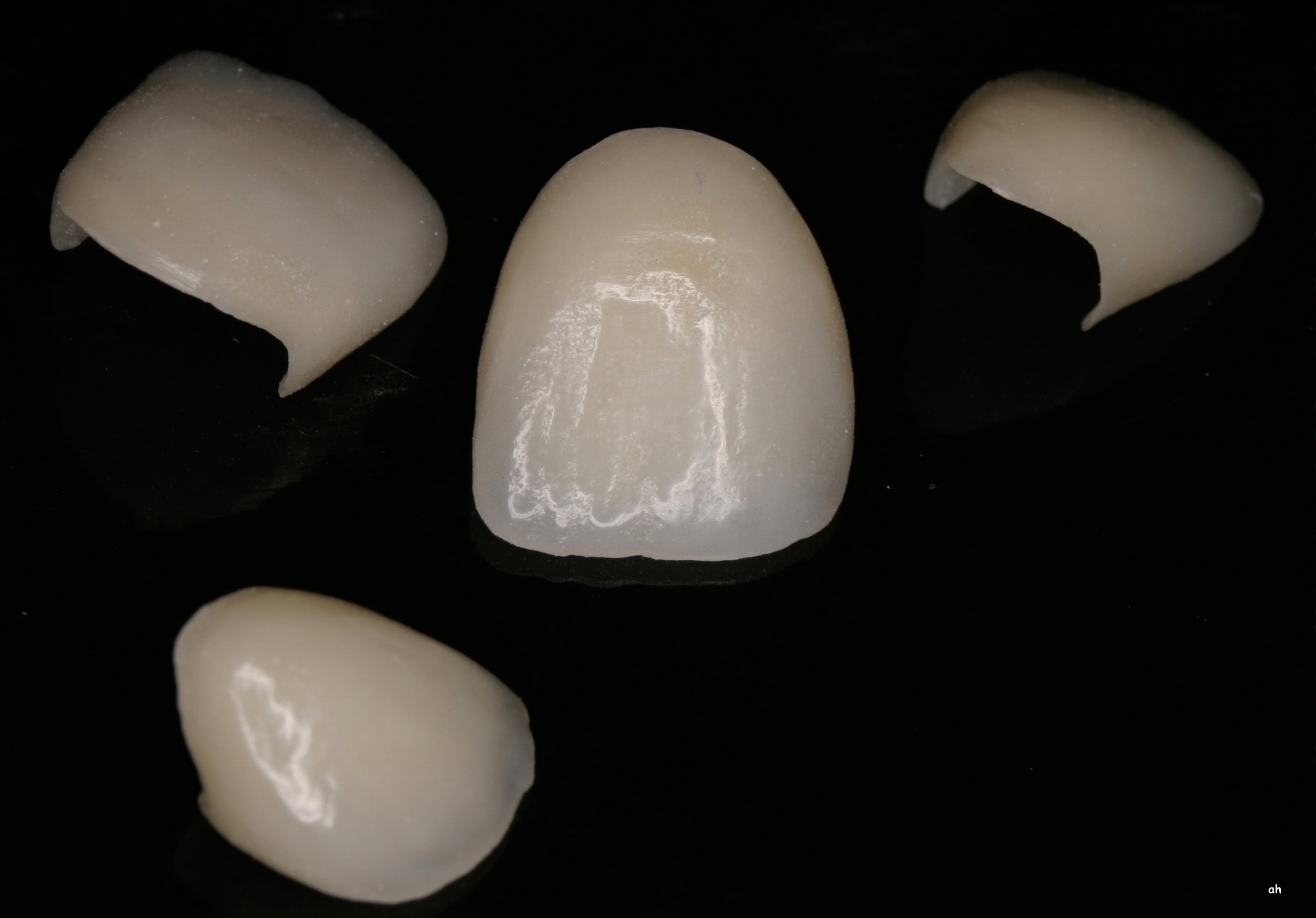 Exemples de facettes en céramique