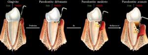 parodontite déchaussement dents stades Cabinet Haerri Lausanne