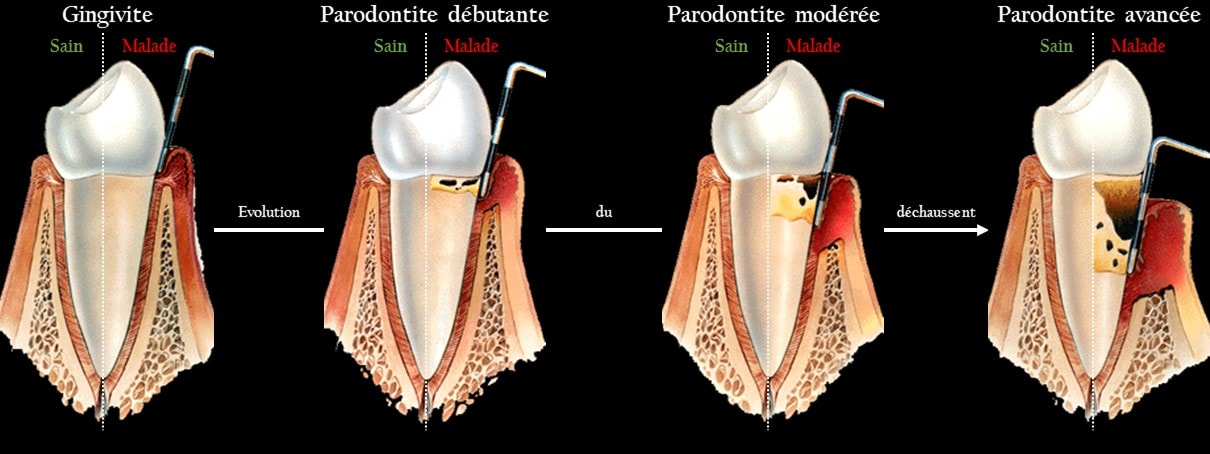 Illustration des stades de la parodontite et du déchaussement des dents