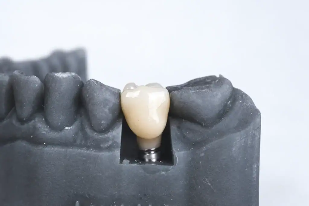 Une prothèse fixe pour retrouver un sourire stable, naturel et durable.