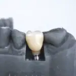 Une prothèse fixe pour retrouver un sourire stable, naturel et durable.