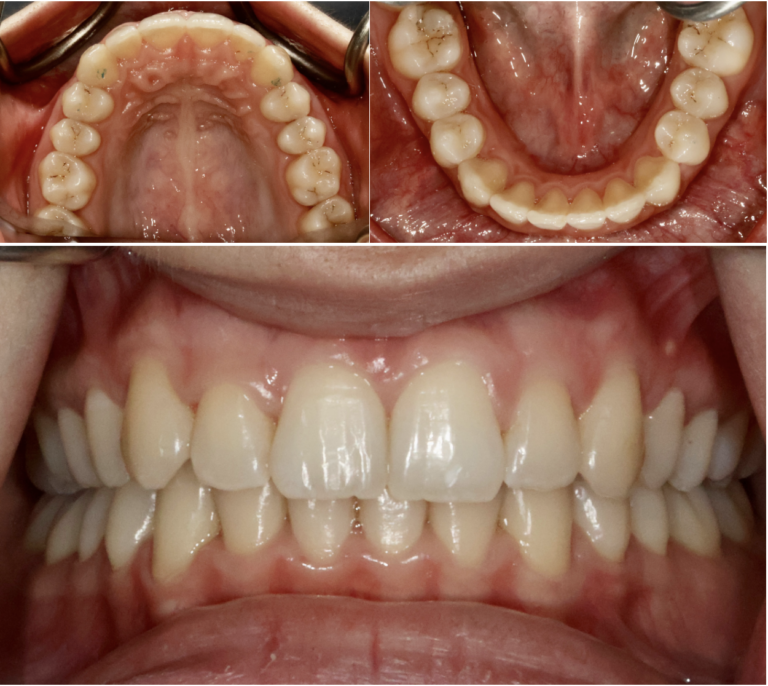 situation initiale d'un traitement orthodontique avec gouttières transparentes à Lausanne - après