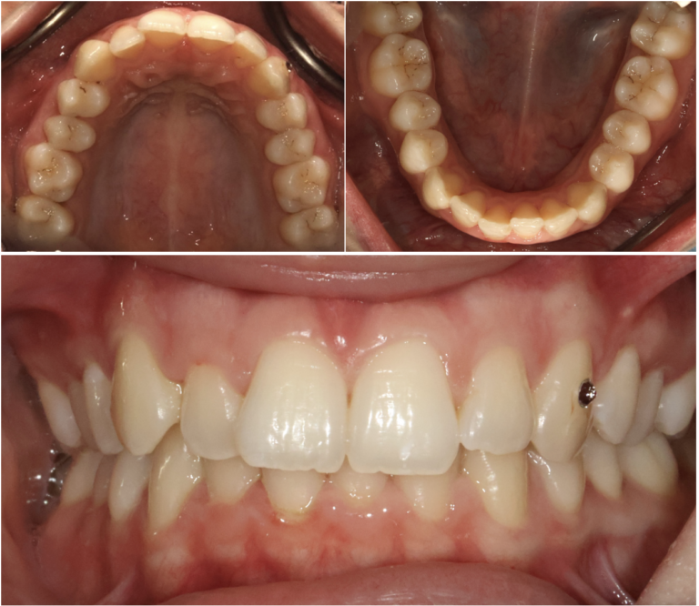 situation initiale d'un traitement orthodontique avec gouttières transparentes à Lausanne - avant