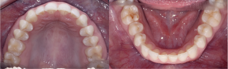situation finale d'un traitement orthodontique avec gouttières transparantes
