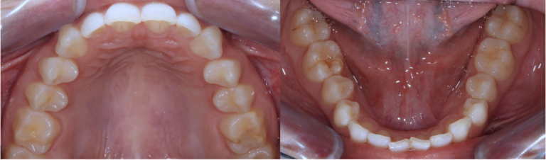 situation initiale d'un traitement orthodontique avec gouttières transparantes